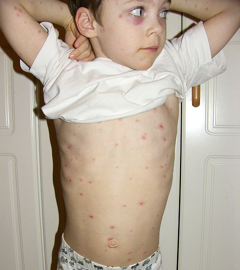 chicken pox. has got the chicken pox?